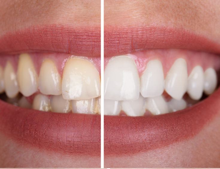 Blanchiment naturel des dents : ce qui marche vraiment (sans produits chimiques)