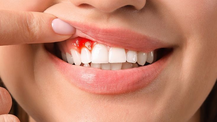 Gencives qui saignent : pourquoi c'est plus sérieux que vous ne le pensez et comment réagir