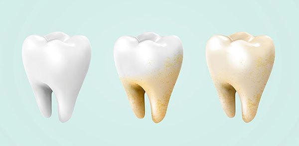 Dents blanches : pourquoi elles jaunissent et comment retrouver leur éclat
