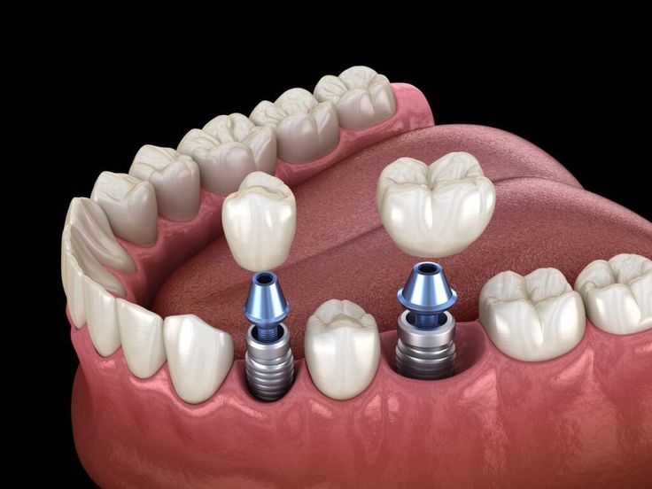 Implants dentaires : ce que personne ne vous dit avant
